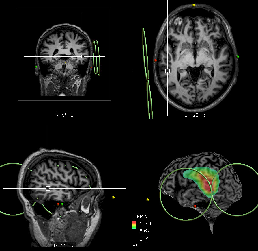 You are currently viewing EA 7466 – Imagerie et Stratégies Thérapeutiques de la Schizophrénie · ISTS