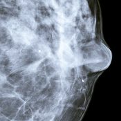 Le Mammobile sillonnera la Normandie pour dépister le cancer du sein